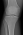 Røntgenbilde av kne